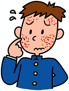 中学生にきびに漢方